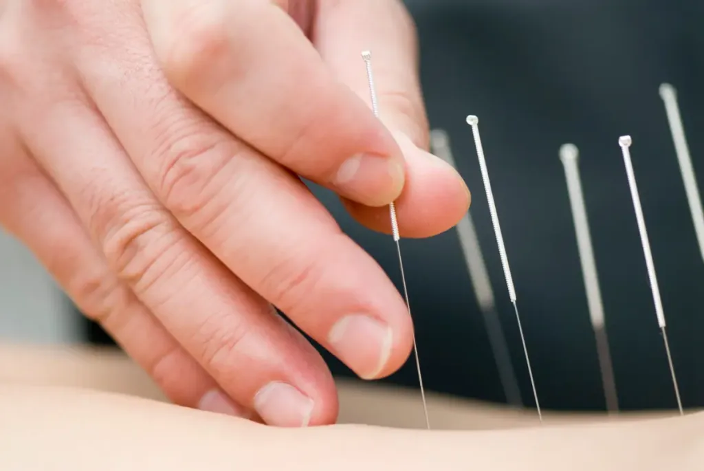 aiguilles d'acupuncture plantées dans le dos d'une personne